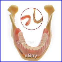 GER Dental Implant Teeth Model Lower Jaw for Study & Teach ZYR-2014 FREE SHIP